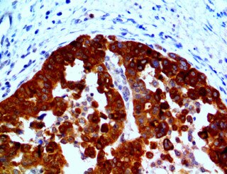 IHC of HE4 on a FFPE Ovarian Cancer Tissue
